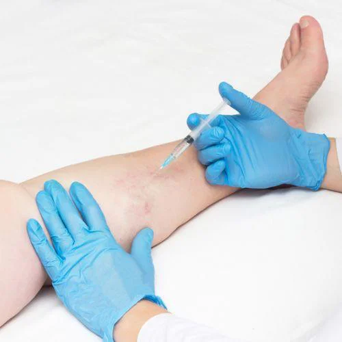 Behandlung der Venen und Besenreiser