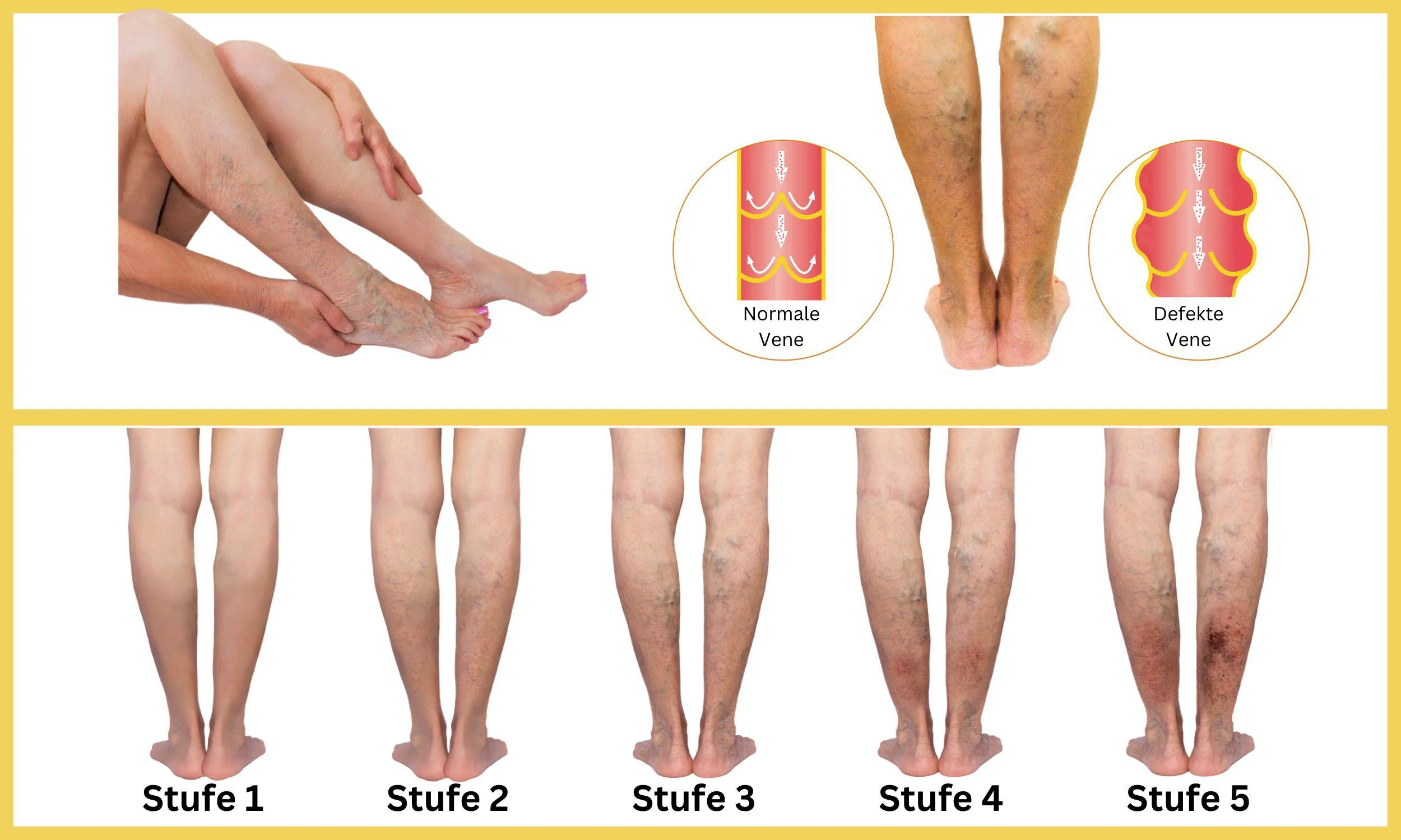 Die Stufen der Venensch&auml;digung
